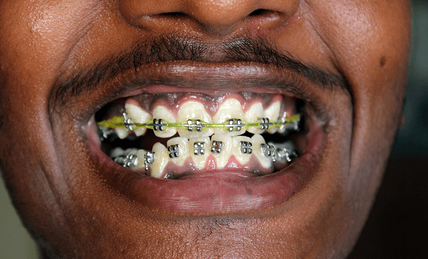 cost of dental braces in nigeria