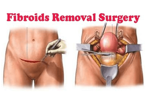 cost of fibroid surgery in nigeria